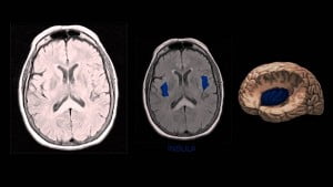 Exame de neuroimagem não é essencial para diagnóstico da enxaqueca