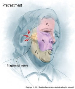 Toxina botulínica para neuralgia do trigêmeo