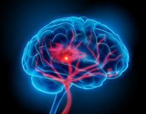 Dor Neuropática – O que é dor neuropática?