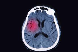 Aneurismas Cerebrais – O que é Aneurisma Cerebral?
