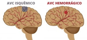 O que é e como prevenir o AVC?