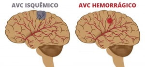 Tipos De Avc