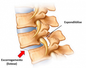 Espondilolistese