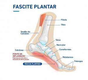 Fascite Plantar